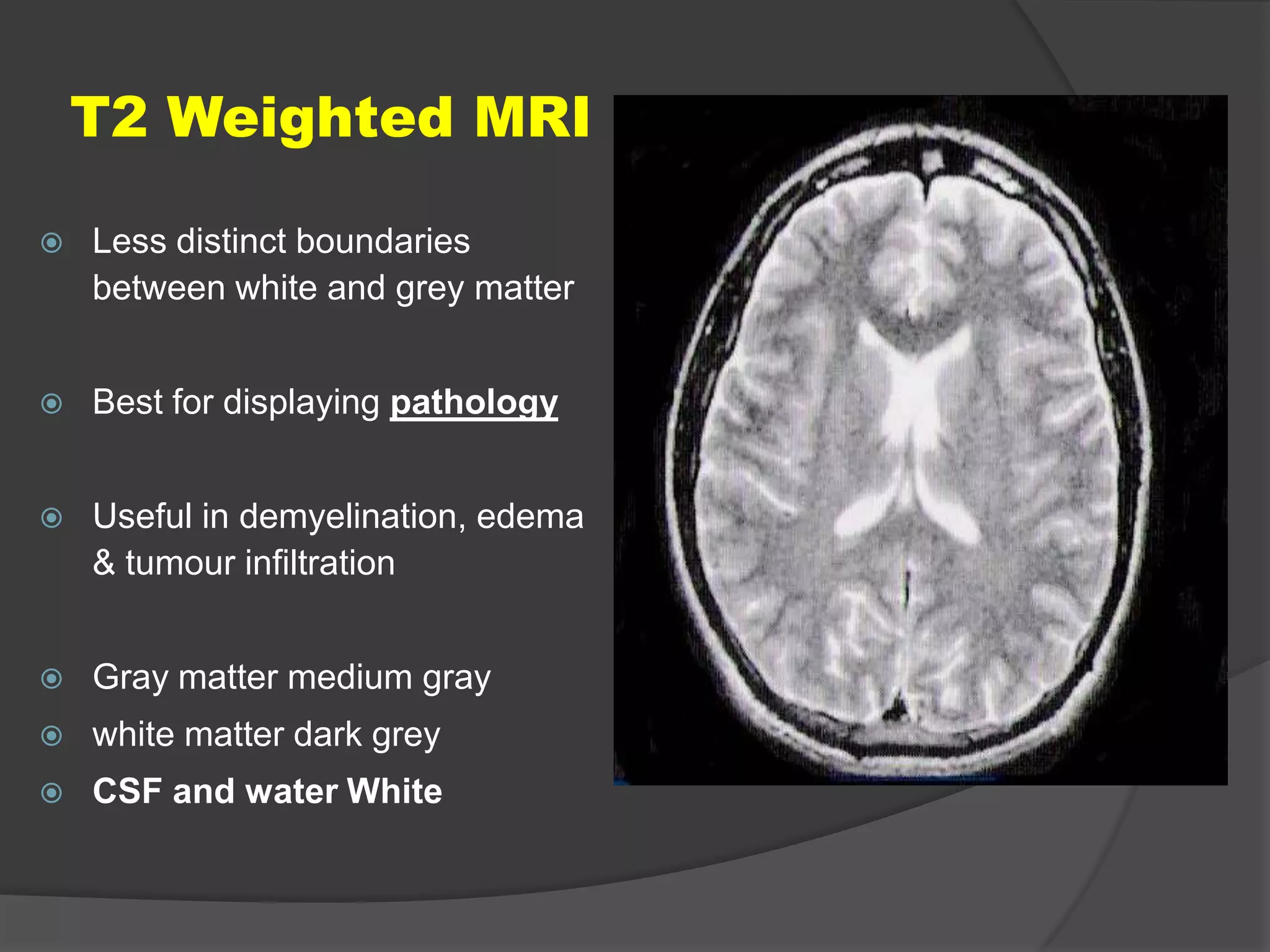 T2 Weighted MRI


Less distinct boundaries
between white and grey matter



Best for displaying pathology



Useful in demyelination, edema
& tumour infiltration



Gray matter medium gray



white matter dark grey



CSF and water White

 