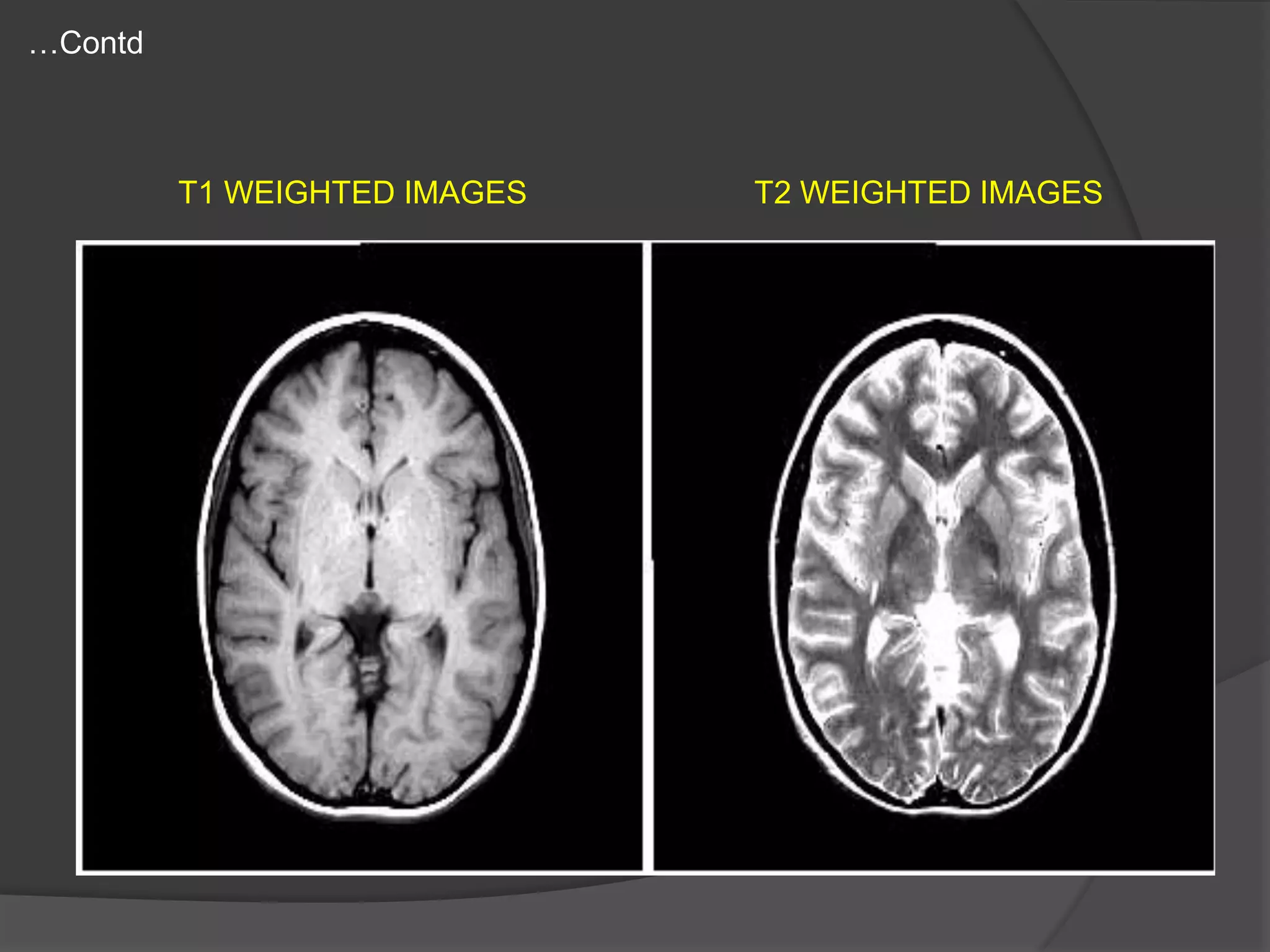 …Contd

T1 WEIGHTED IMAGES

T2 WEIGHTED IMAGES

 