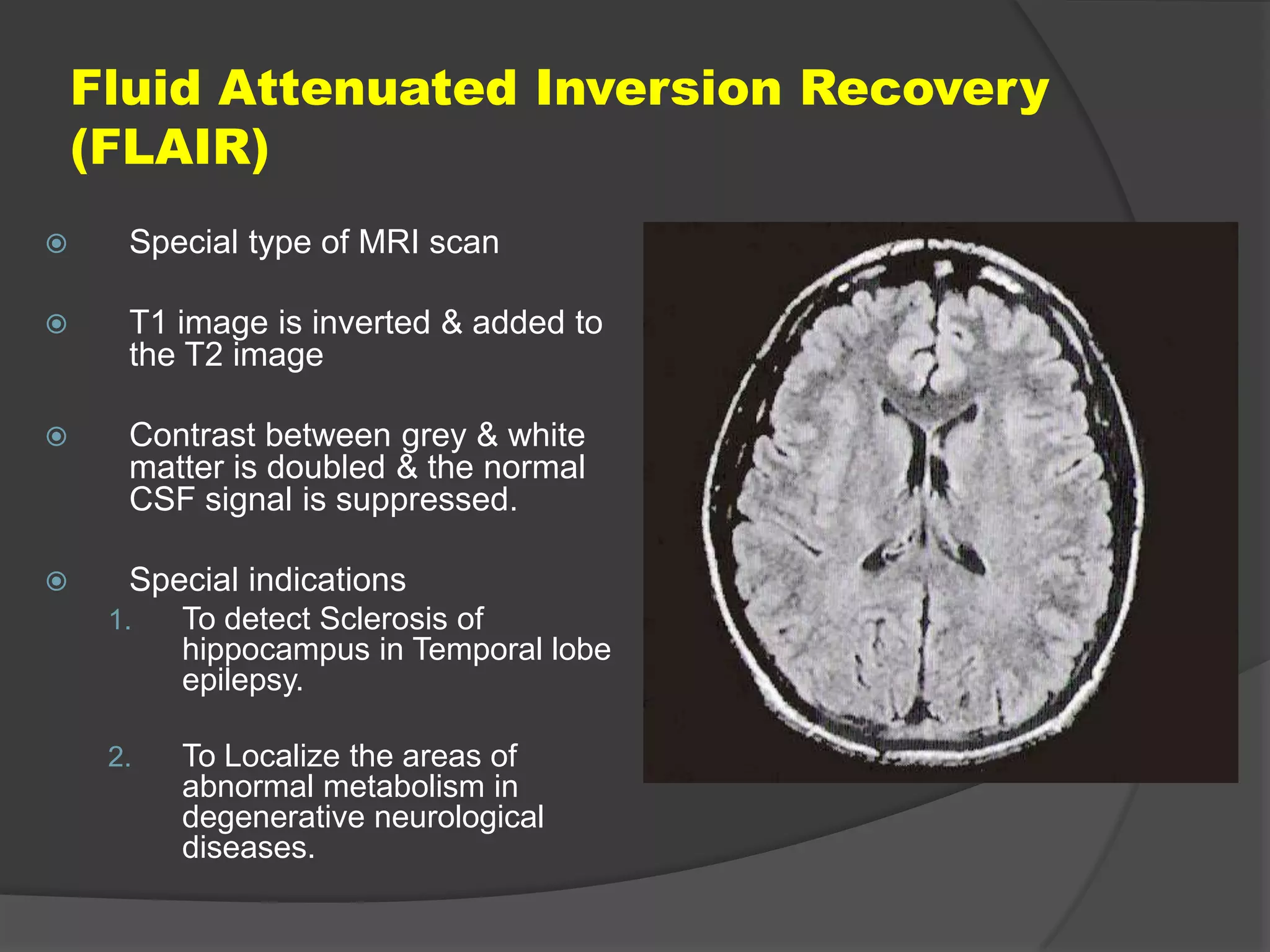 Fluid Attenuated Inversion Recovery
(FLAIR)


Special type of MRI scan



T1 image is inverted & added to
the T2 image



Contrast between grey & white
matter is doubled & the normal
CSF signal is suppressed.



Special indications
1.

To detect Sclerosis of
hippocampus in Temporal lobe
epilepsy.

2.

To Localize the areas of
abnormal metabolism in
degenerative neurological
diseases.

 