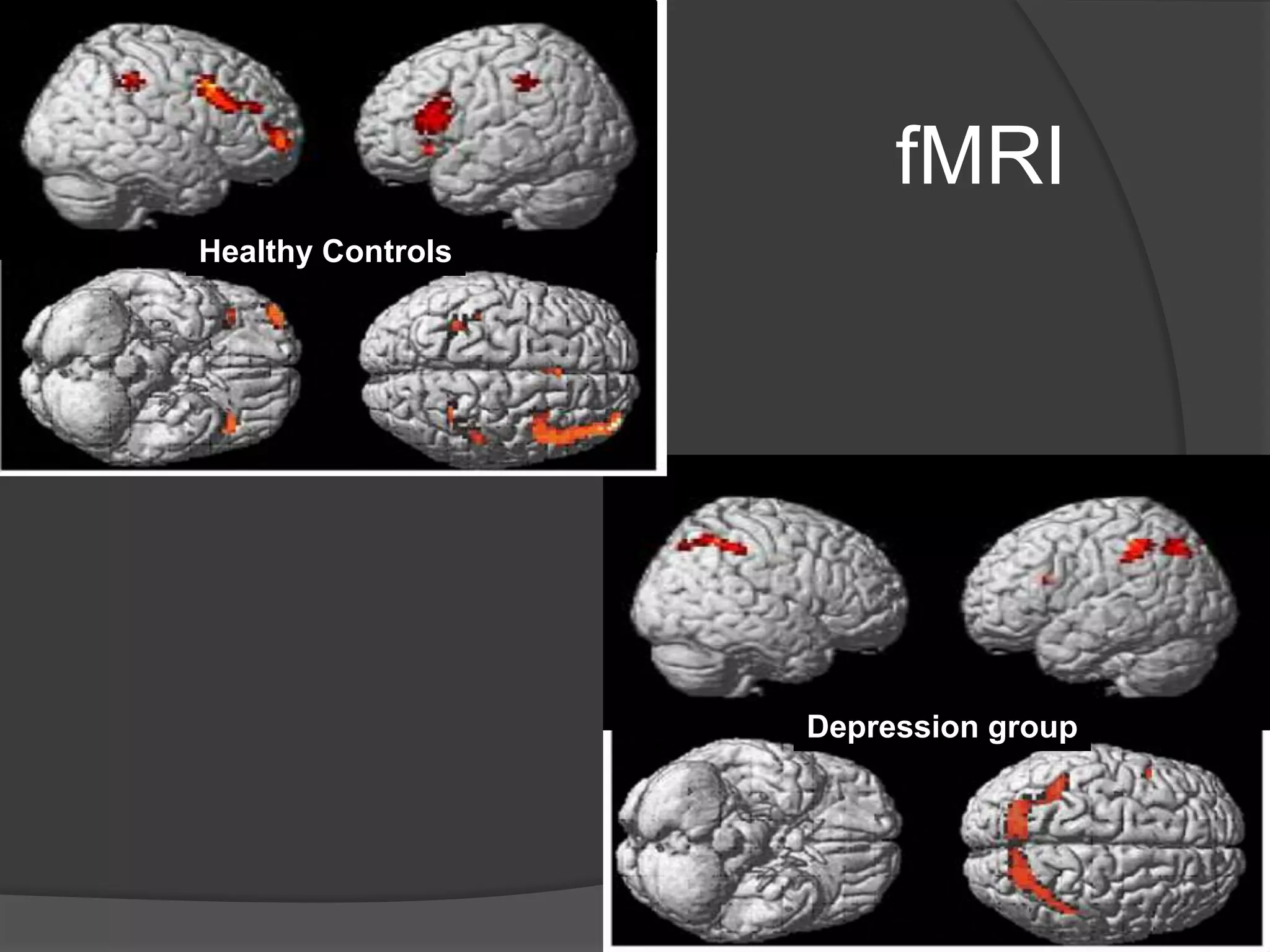 fMRI
Healthy Controls

Depression group

 