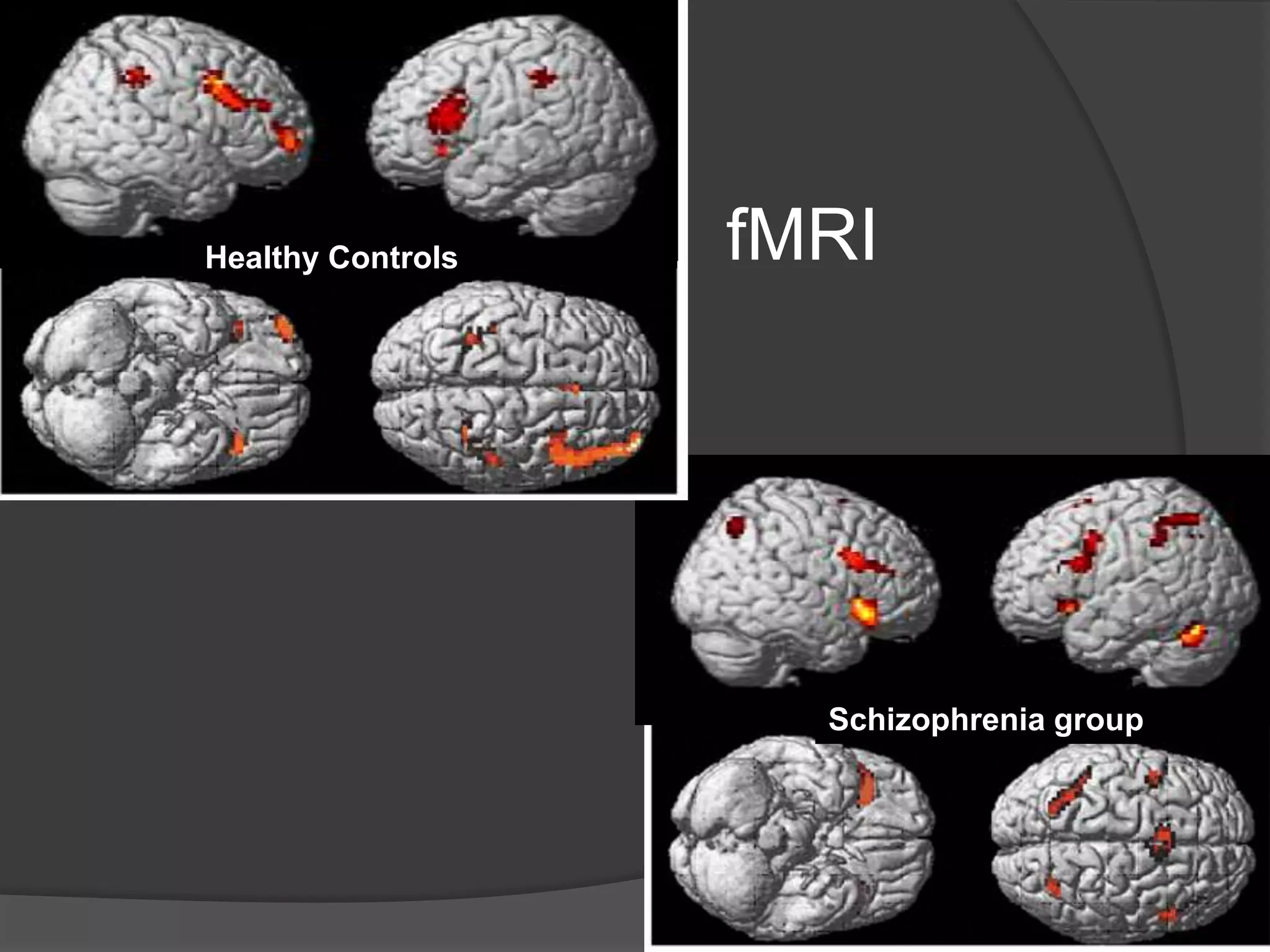 Healthy Controls

fMRI

Schizophrenia group

 
