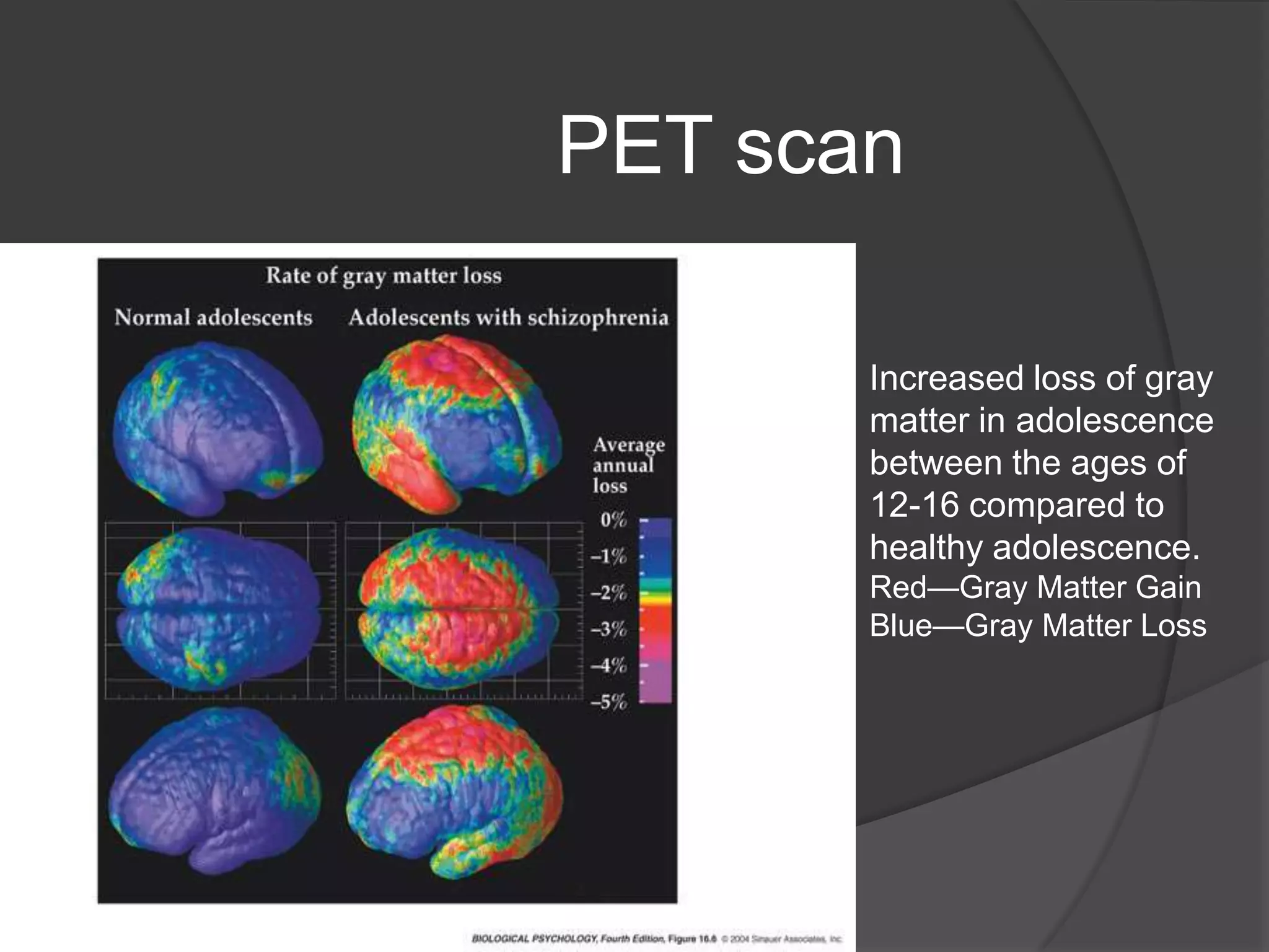 PET scan
Increased loss of gray
matter in adolescence
between the ages of
12-16 compared to
healthy adolescence.
Red—Gray Matter Gain
Blue—Gray Matter Loss

 