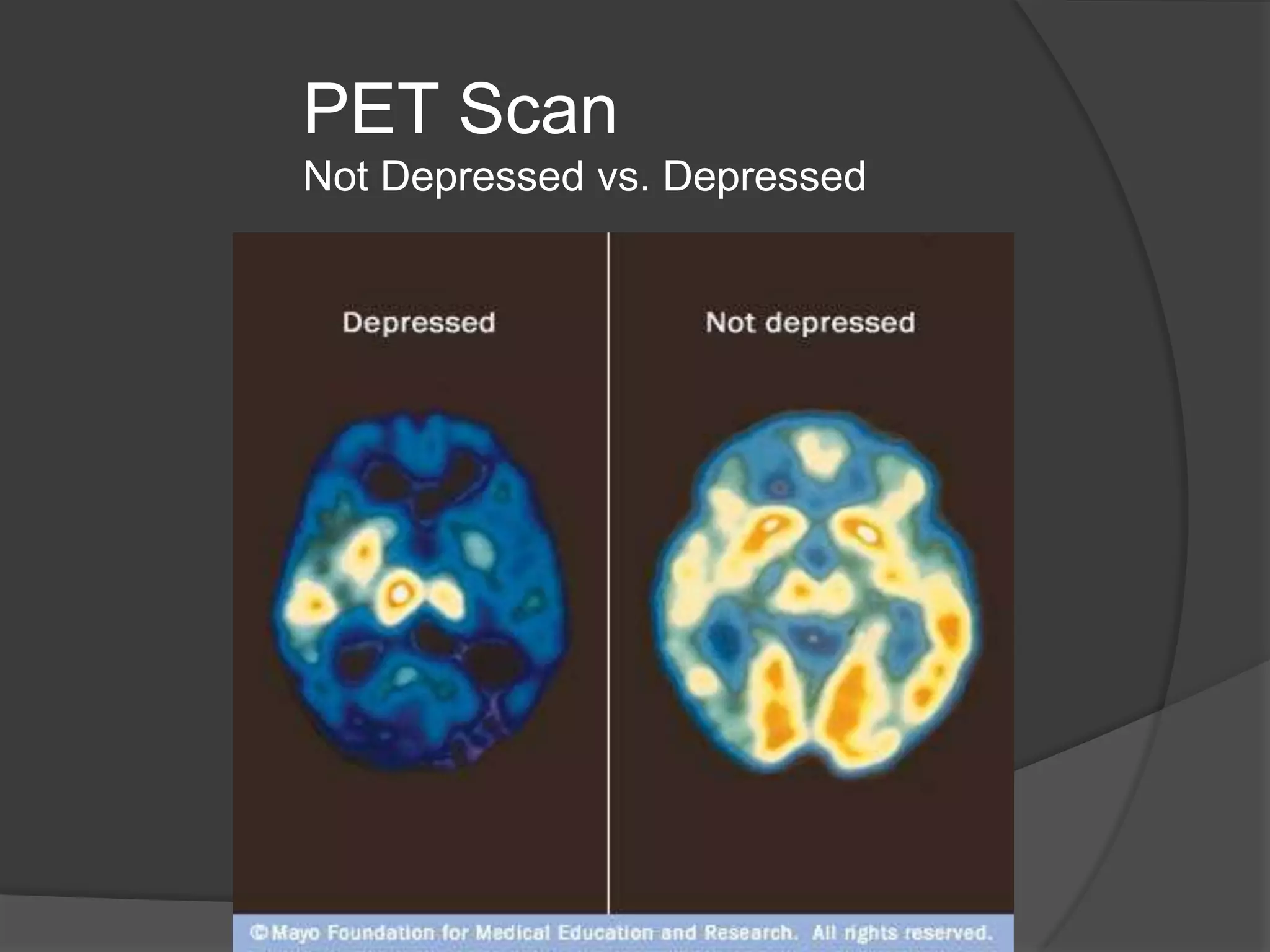 PET Scan
Not Depressed vs. Depressed

 