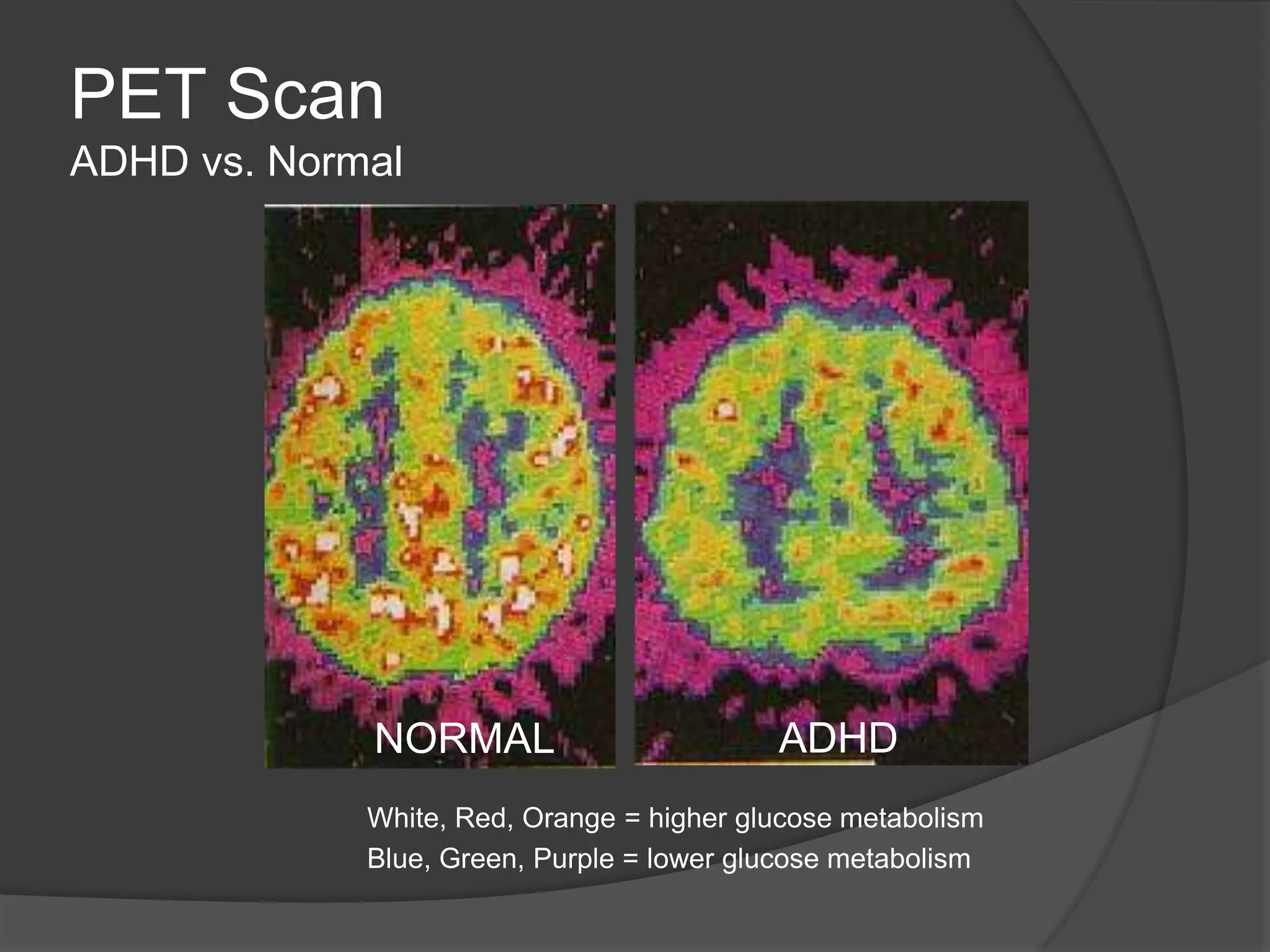 PET Scan
ADHD vs. Normal

NORMAL

ADHD

White, Red, Orange = higher glucose metabolism
Blue, Green, Purple = lower glucose metabolism

 