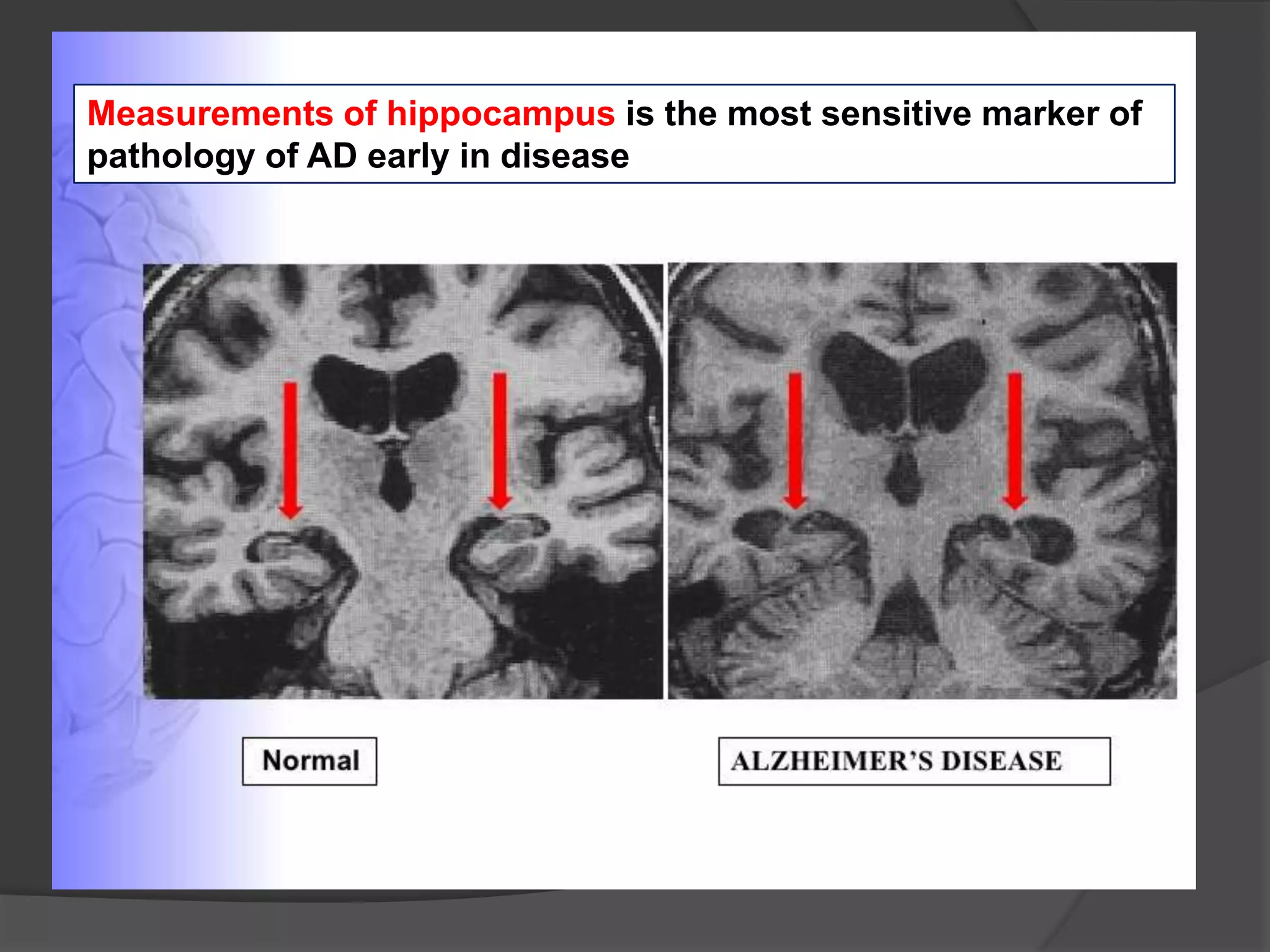 Measurements of hippocampus is the most sensitive marker of
pathology of AD early in disease

 