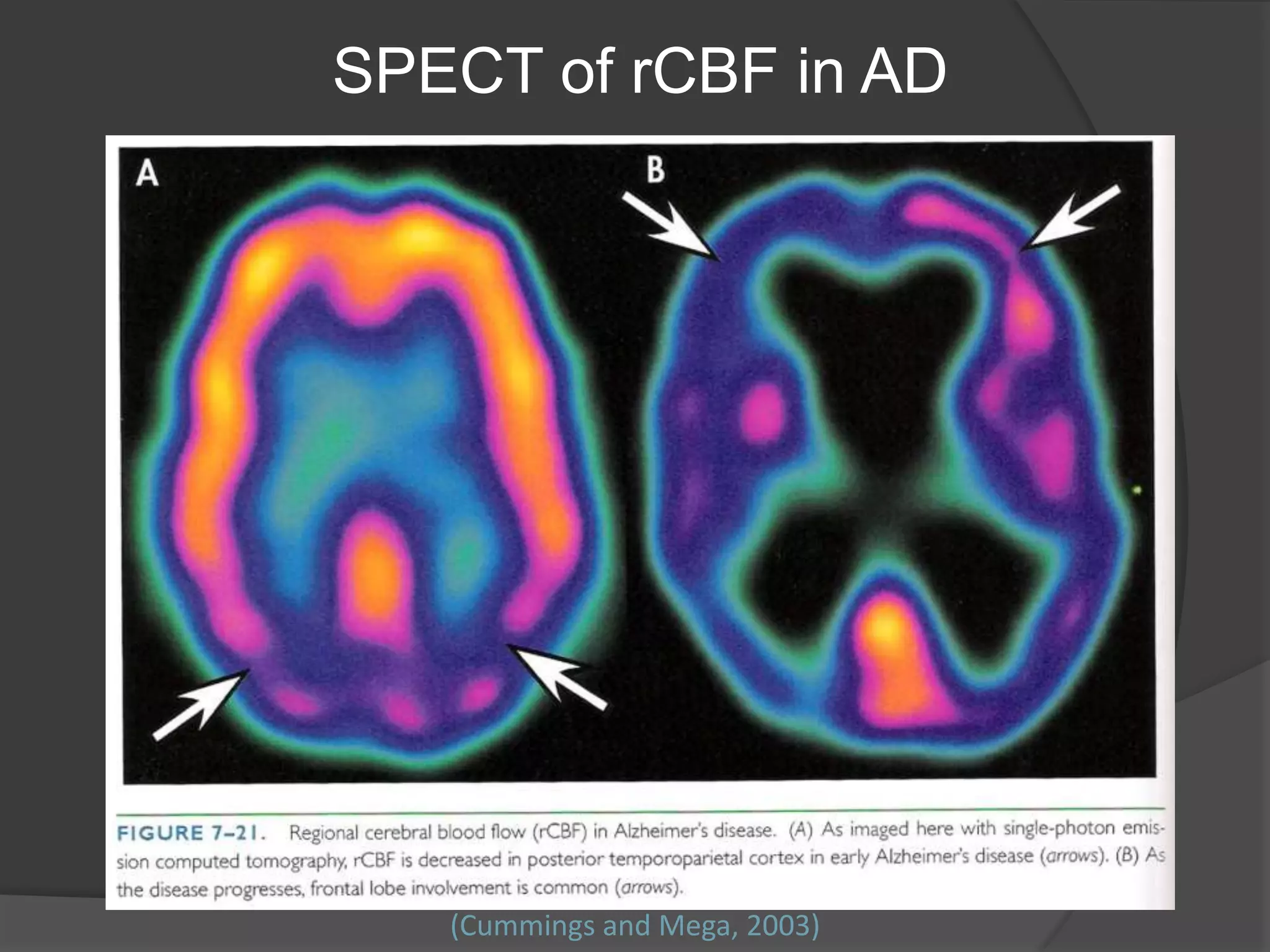 SPECT of rCBF in AD

(Cummings and Mega, 2003)

 