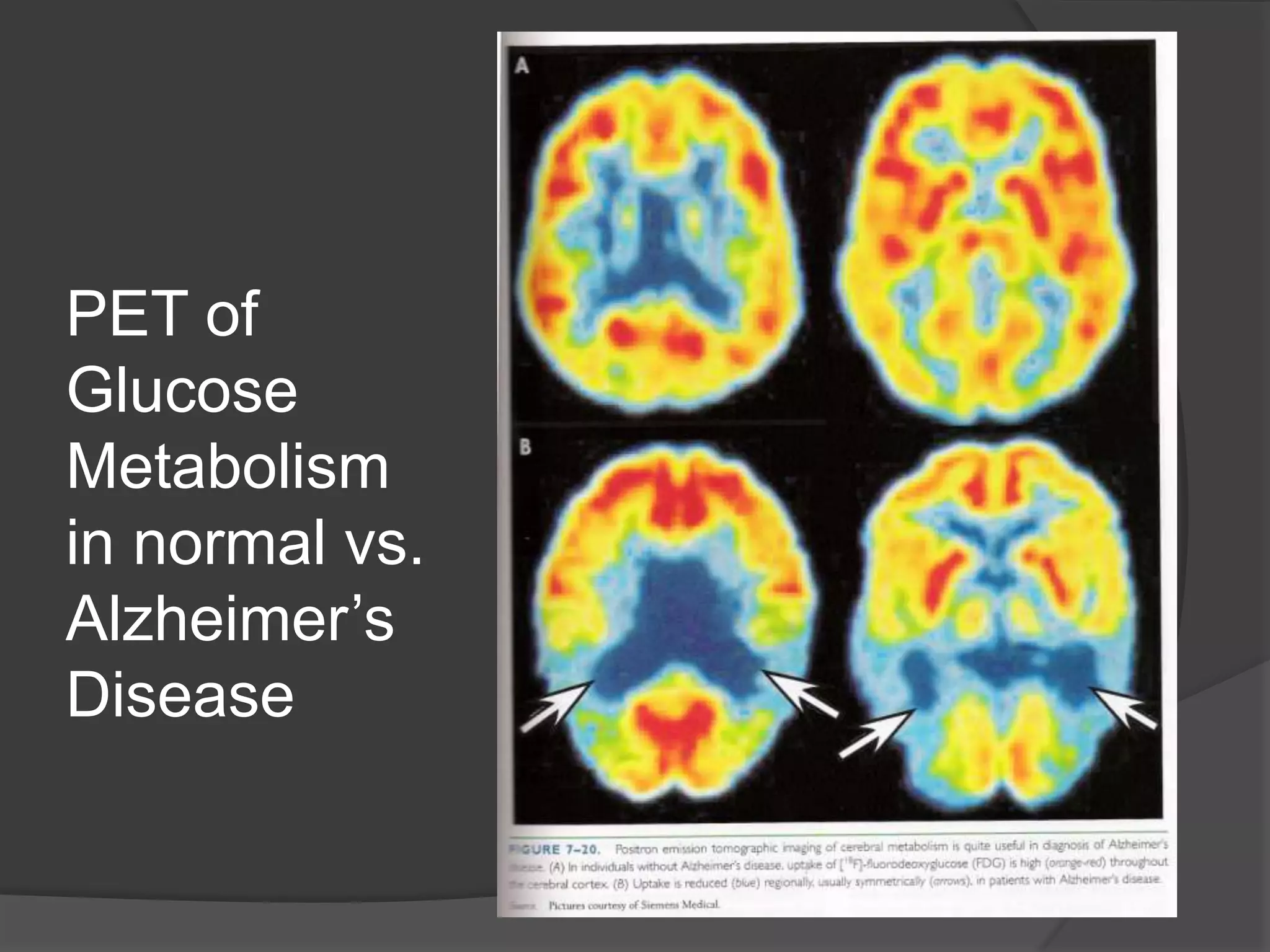 PET of
Glucose
Metabolism
in normal vs.
Alzheimer’s
Disease

 