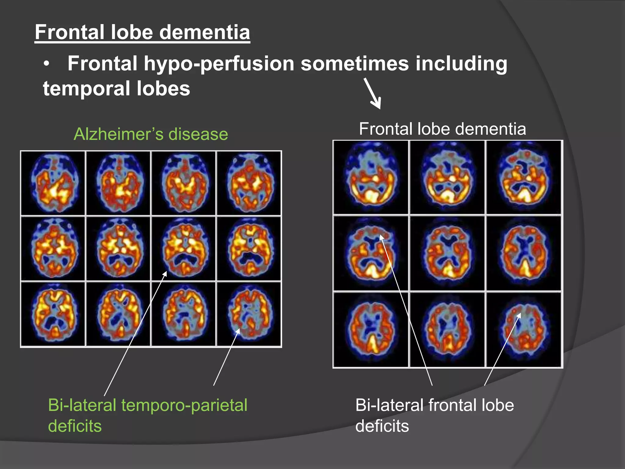 Frontal lobe dementia
• Frontal hypo-perfusion sometimes including
temporal lobes
Alzheimer’s disease

Bi-lateral temporo-parietal
deficits

Frontal lobe dementia

Bi-lateral frontal lobe
deficits

 