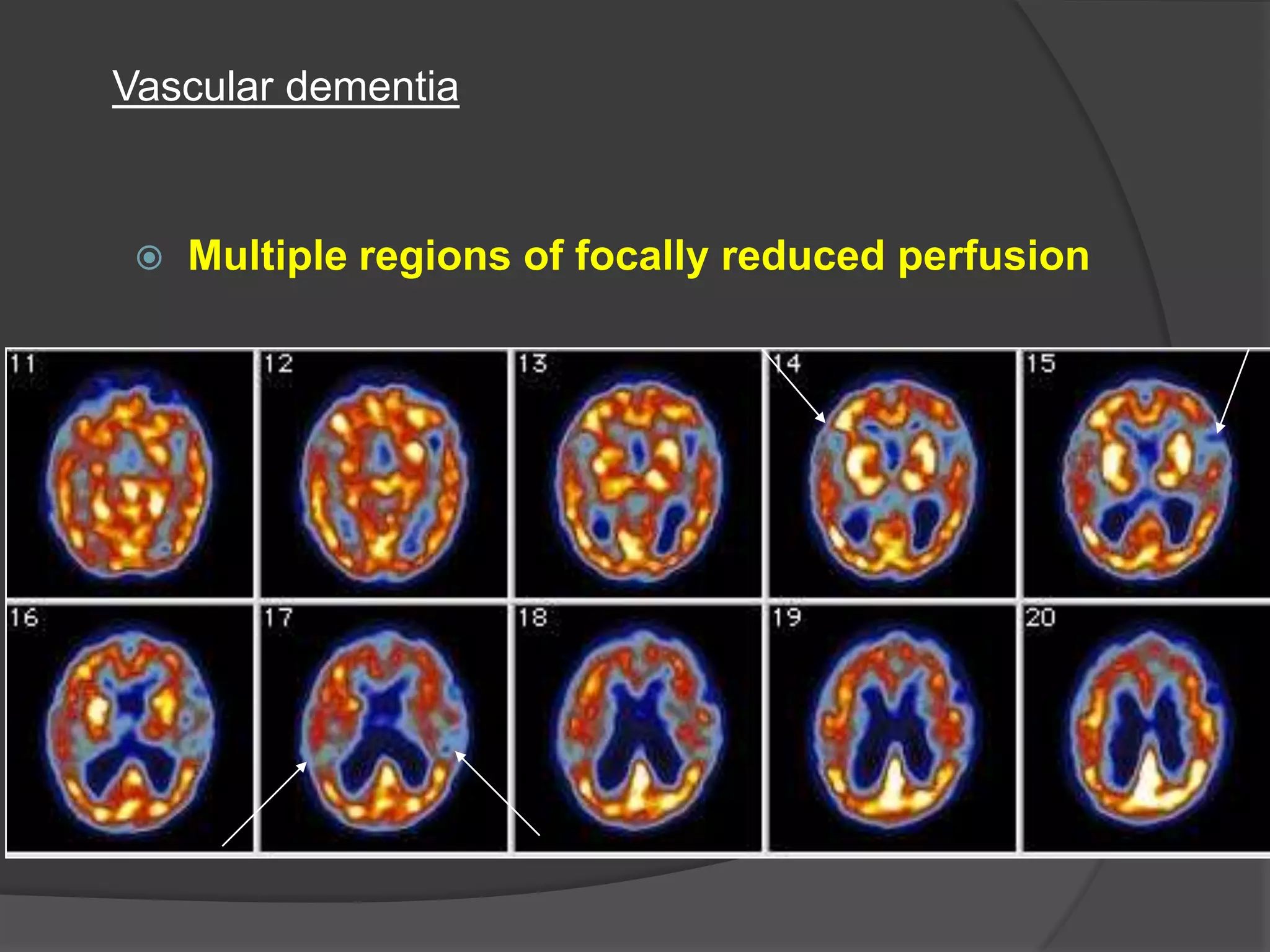 Vascular dementia



Multiple regions of focally reduced perfusion

 
