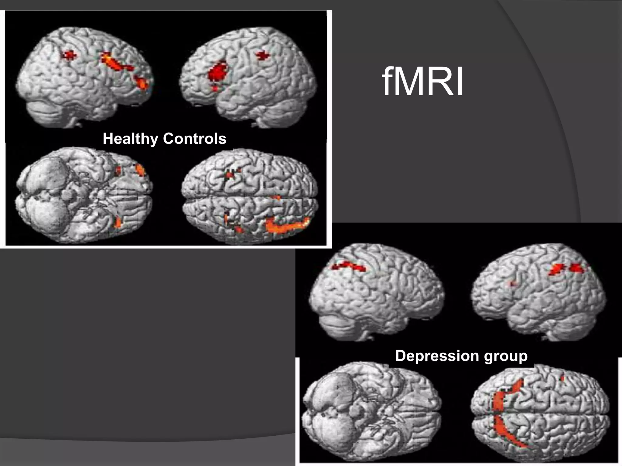 fMRI
Healthy Controls

Depression group

 