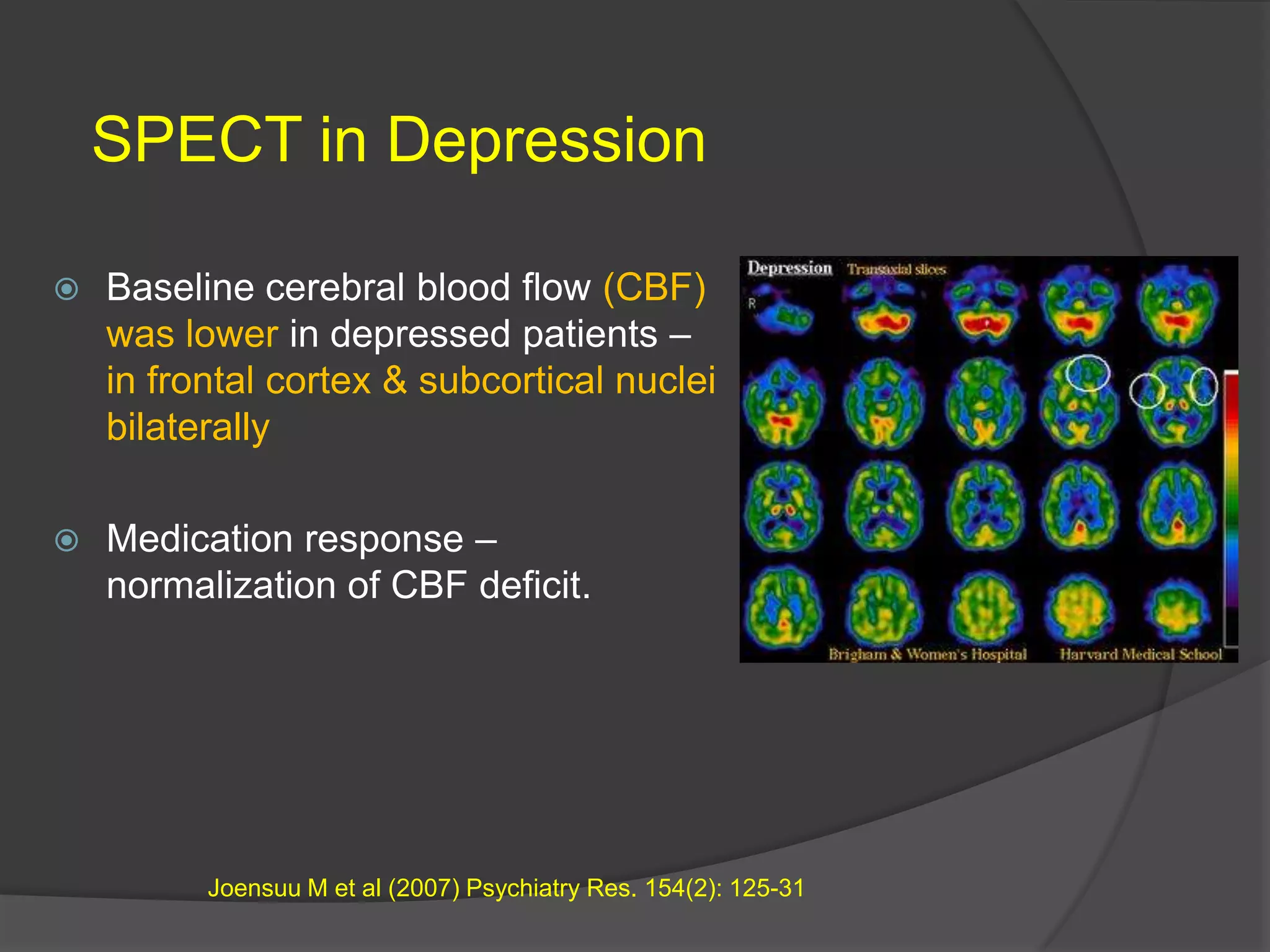 SPECT in Depression


Baseline cerebral blood flow (CBF)
was lower in depressed patients –
in frontal cortex & subcortical nuclei
bilaterally



Medication response –
normalization of CBF deficit.

Joensuu M et al (2007) Psychiatry Res. 154(2): 125-31

 