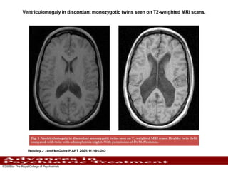 Ventriculomegaly in discordant monozygotic twins seen on T2-weighted MRI scans.

Woolley J , and McGuire P APT 2005;11:195-202

©2005 by The Royal College of Psychiatrists

 