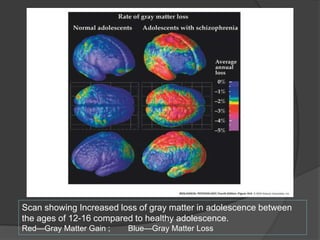 Scan showing Increased loss of gray matter in adolescence between
the ages of 12-16 compared to healthy adolescence.
Red—Gray Matter Gain ;

Blue—Gray Matter Loss

 