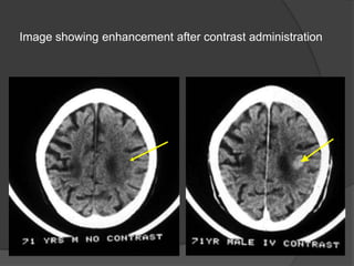 Image showing enhancement after contrast administration

 