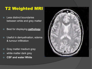 T2 Weighted MRI


Less distinct boundaries
between white and grey matter



Best for displaying pathology



Useful in demyelination, edema
& tumour infiltration



Gray matter medium gray



white matter dark grey



CSF and water White

 