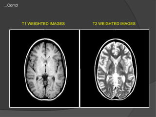 …Contd

T1 WEIGHTED IMAGES

T2 WEIGHTED IMAGES

 