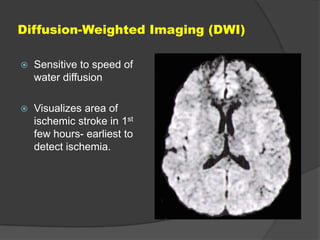 Diffusion-Weighted Imaging (DWI)


Sensitive to speed of
water diffusion



Visualizes area of
ischemic stroke in 1st
few hours- earliest to
detect ischemia.

 
