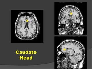 Caudate
Head

 