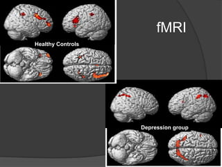 fMRI
Healthy Controls

Depression group

 