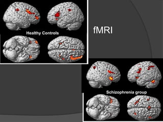 Healthy Controls

fMRI

Schizophrenia group

 