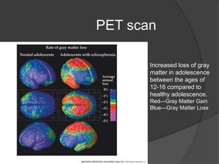 PET scan
Increased loss of gray
matter in adolescence
between the ages of
12-16 compared to
healthy adolescence.
Red—Gray Matter Gain
Blue—Gray Matter Loss

 