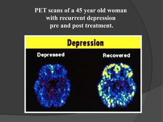 PET scans of a 45 year old woman
with recurrent depression
pre and post treatment.

 