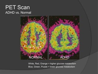 PET Scan
ADHD vs. Normal

NORMAL

ADHD

White, Red, Orange = higher glucose metabolism
Blue, Green, Purple = lower glucose metabolism

 
