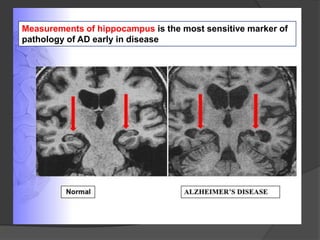 Measurements of hippocampus is the most sensitive marker of
pathology of AD early in disease

 