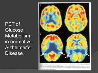 PET of
Glucose
Metabolism
in normal vs.
Alzheimer’s
Disease

 