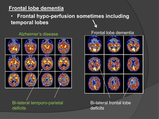 Frontal lobe dementia
• Frontal hypo-perfusion sometimes including
temporal lobes
Alzheimer’s disease

Bi-lateral temporo-parietal
deficits

Frontal lobe dementia

Bi-lateral frontal lobe
deficits

 