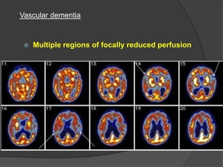Vascular dementia



Multiple regions of focally reduced perfusion

 