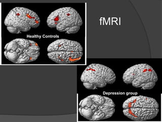 fMRI
Healthy Controls

Depression group

 
