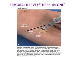 Nerve block | PPTX