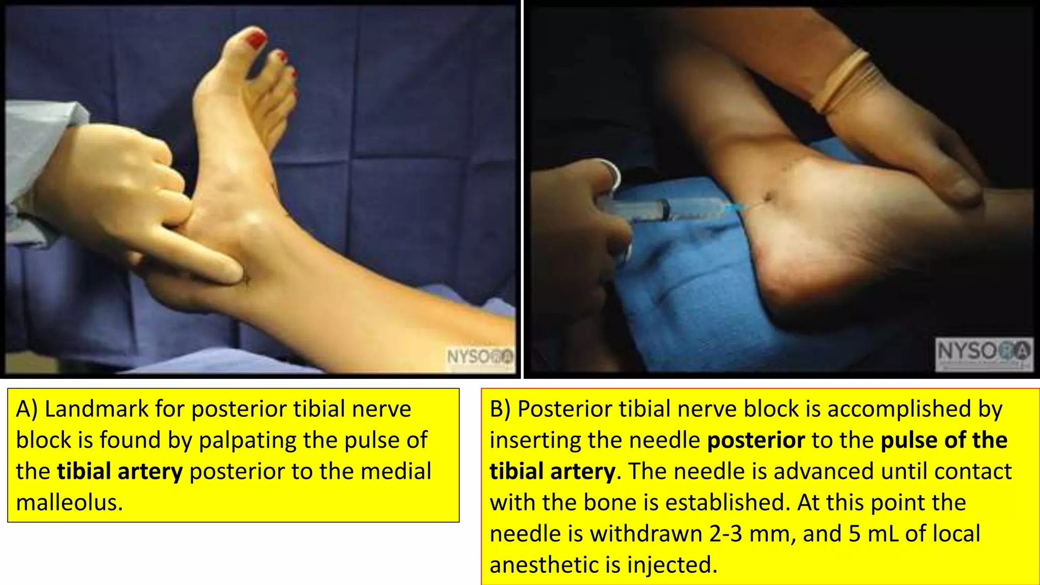 Peripheral Nerve block(ankle block,wrist block, digital block) | PPTX
