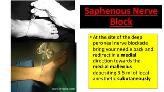 Peripheral Nerve block(ankle block,wrist block, digital block) | PPTX