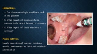 Comprehensive Guide to Mandibular and Maxillary Nerve Block Techniques ...