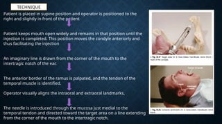 Comprehensive Guide to Mandibular and Maxillary Nerve Block Techniques ...