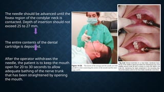 Comprehensive Guide to Mandibular and Maxillary Nerve Block Techniques ...