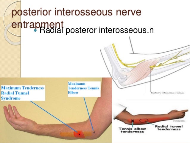 nerve compression syndrome nerve compression syndrome