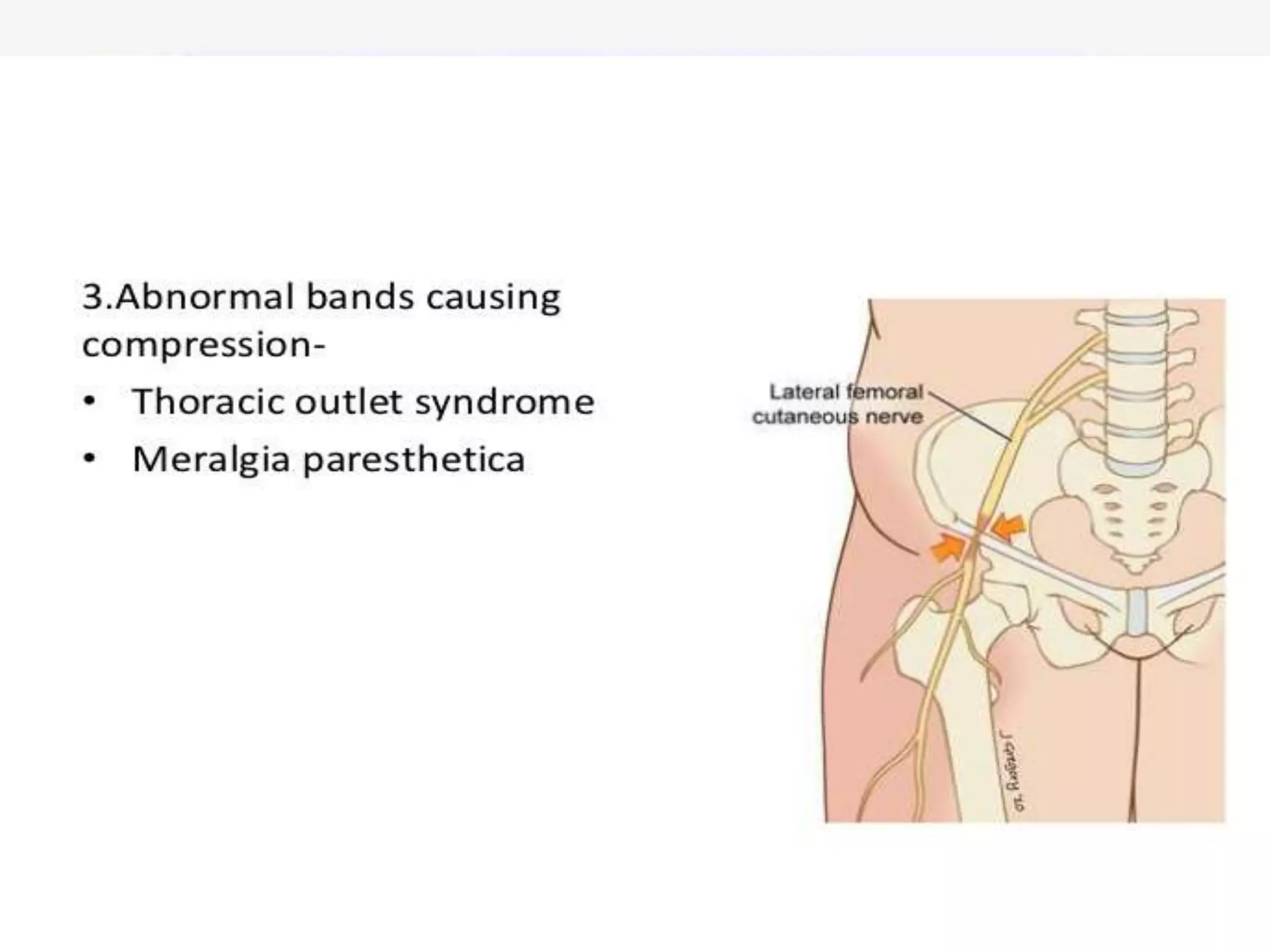 Compression Syndrom Nerve compression syndrome | PPTX