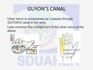 GUYON’S CANAL
• Ulnar nerve is compressed as it passes through
GUYON’S canal in the wrist.
• Less common than entrapment of the ulnar nerve at the
elbow.
 