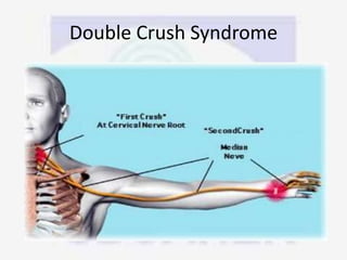 Double Crush Syndrome
 
