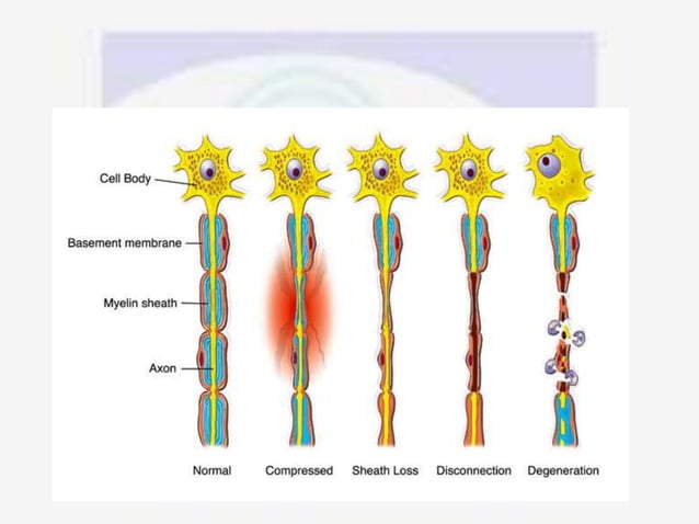 Compressive Neuropathy Chest Nerve compression syndrome | PPTX