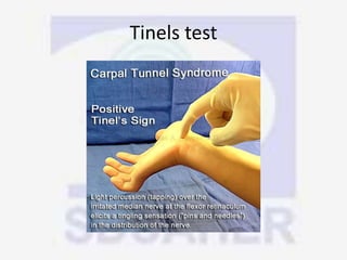 Tinels test
 