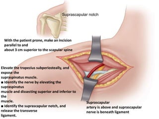 Suprascapular notch
With the patient prone, make an incision
parallel to and
about 3 cm superior to the scapular spine
Suprascapular
artery is above and suprascapular
nerve is beneath ligament
Elevate the trapezius subperiosteally, and
expose the
supraspinatus muscle.
■ Identify the nerve by elevating the
supraspinatus
muscle and dissecting superior and inferior to
the
muscle.
■ Identify the suprascapular notch, and
release the transverse
ligament.
 