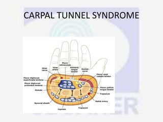CARPAL TUNNEL SYNDROME
 