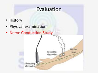 Evaluation
• History
• Physical examination
• Nerve Conduction Study
 