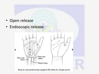 • Open release
• Endoscopic release
 