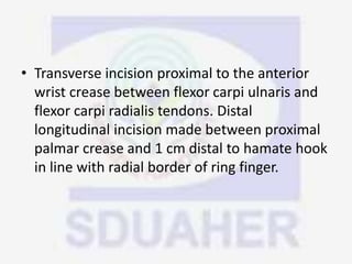 • Transverse incision proximal to the anterior
wrist crease between flexor carpi ulnaris and
flexor carpi radialis tendons. Distal
longitudinal incision made between proximal
palmar crease and 1 cm distal to hamate hook
in line with radial border of ring finger.
 
