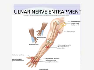 ULNAR NERVE ENTRAPMENT
 
